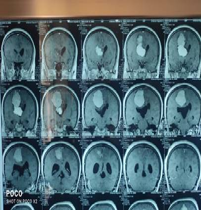 عملية ناجحة لاستئصال ورم سحائي من المخ ... تخلص خمسينية من شلل نصفي 